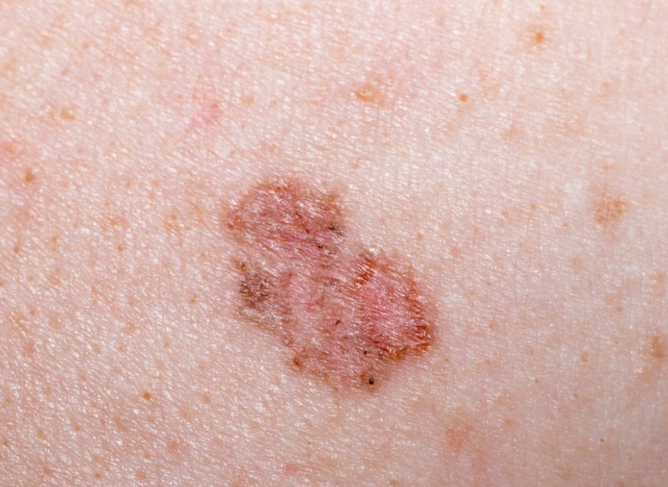 Cilt Kanserinin 6 Belirtisine Dikkat