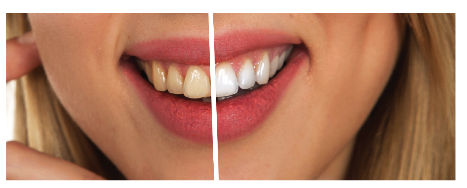 The Importance of Oral Health and Teeth Whiteness